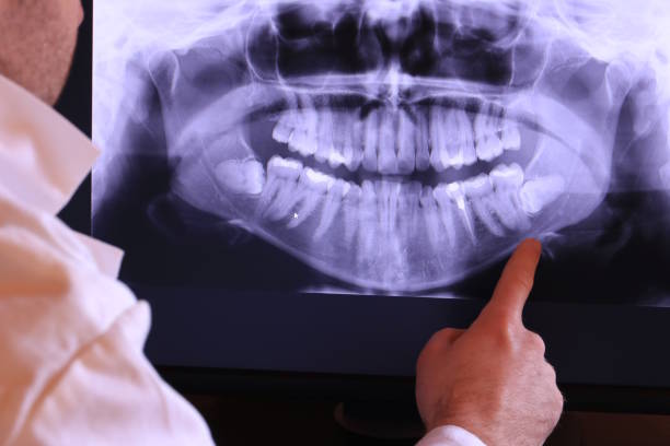 Best Emergency Wisdom Teeth Removal in Telford, TN