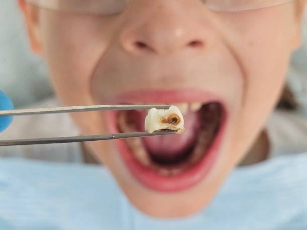 Best Emergency Tooth Extraction in Telford, TN